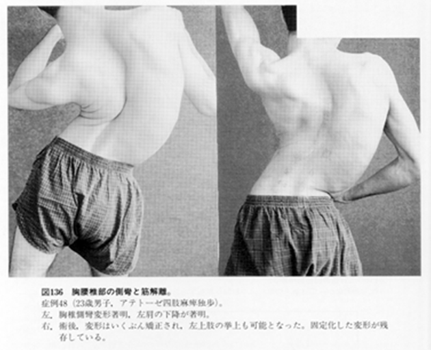 左が手術前の写真、右が手術後の写真です。