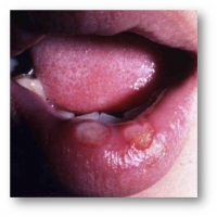 感染３週間後、唇にくぼみができている様子の写真です。