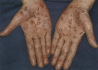 感染から約３か月後、手のひらに痛くもかゆくもないカサカサした斑点が出ている様子の写真です。